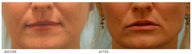Silicone Lip Enhancement/Augmentation