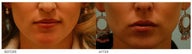 Silicone Lip Enhancement/Augmentation