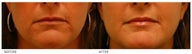 Silicone Lip Enhancement/Augmentation