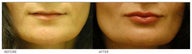 Silicone Lip Enhancement/Augmentation