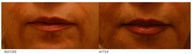 Silicone Lip Enhancement/Augmentation