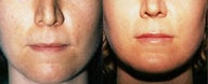 Lip Augmentation
