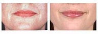 Lip Augmentation with Fat injection