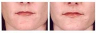  Lip Augmentation with Fat injection