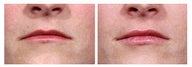 Restylane injection for lip augmentation