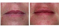 Lip Augmentation with Restylane