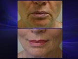 Lip Lift
