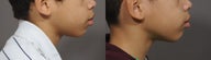 Lip Reduction