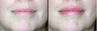 Lip augmentation