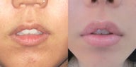Lip Augmentation