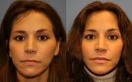 Lip lift