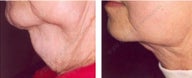 Lipodissolve before and after on chin