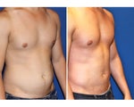 Liposculpture