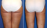 Liposuction