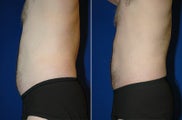 Liposuction