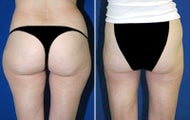 Liposuction