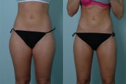 Liposculpture