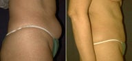 Liposuction