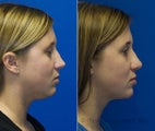 Neck Liposuction