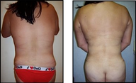 Liposuction