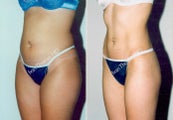Liposuction