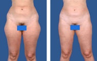 Liposuction