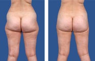 Liposuction