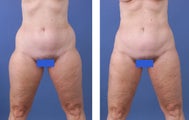 Liposuction