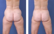 Liposuction