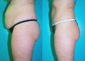 Tummy Tuck with Liposuction