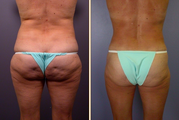 Liposuction