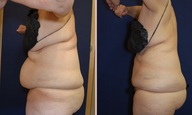 Abdomen Liposuction