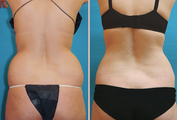 Back / Waist Lipo