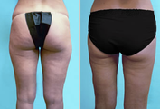 Hips - Liposuction