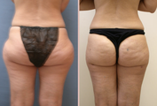 Thigh Liposuction