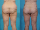 Liposuction