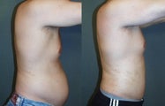 Liposuction