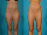 Liposuction