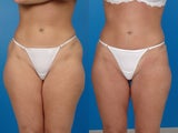 Liposuction