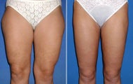 Liposuction
