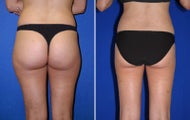 Liposuction
