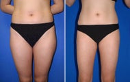 Liposuction