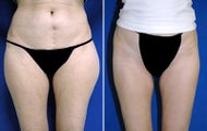 Liposuction
