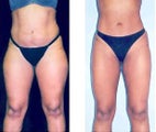 Liposuction