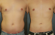 Liposuction