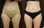 liposuction abdomen, inner and outer thighs