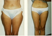 Liposuction to Thighs