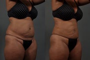 Liposuction of Abdomen