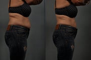 Liposuction Abdomen