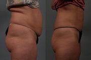Liposuction of Abdomen and Flanks